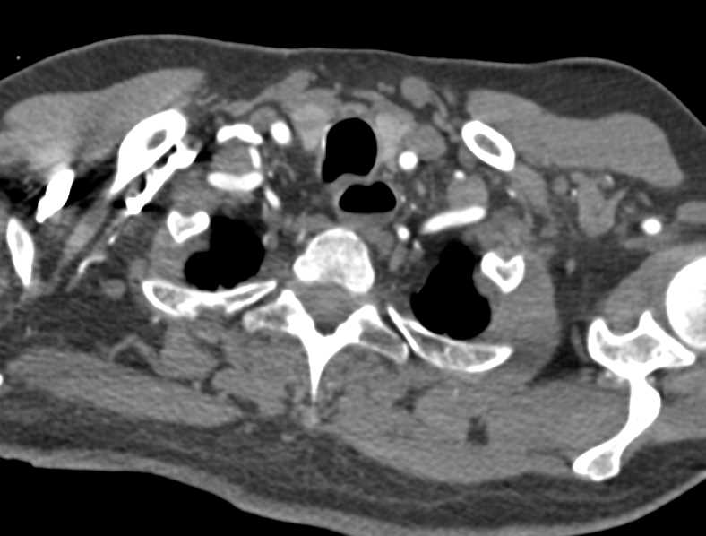 Gastric Volvulus - CTisus CT Scan