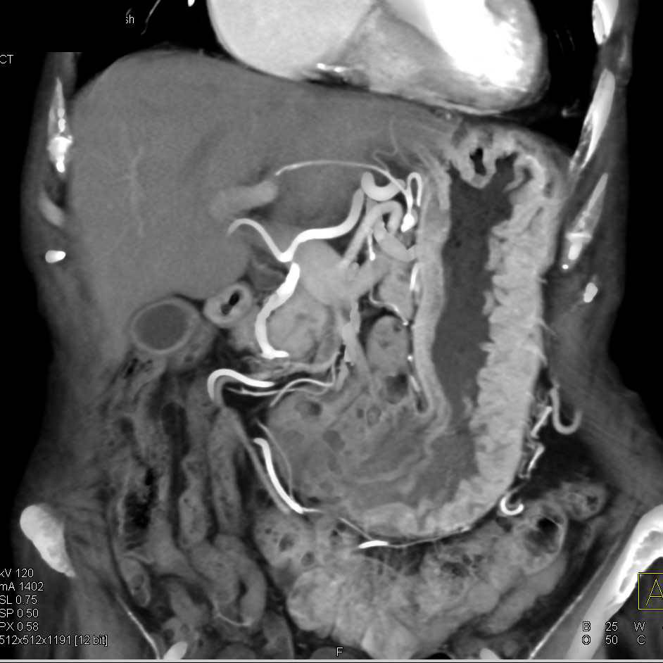 Zollinger-Ellison Syndrome with Thickened Gastric Folds - CTisus CT Scan