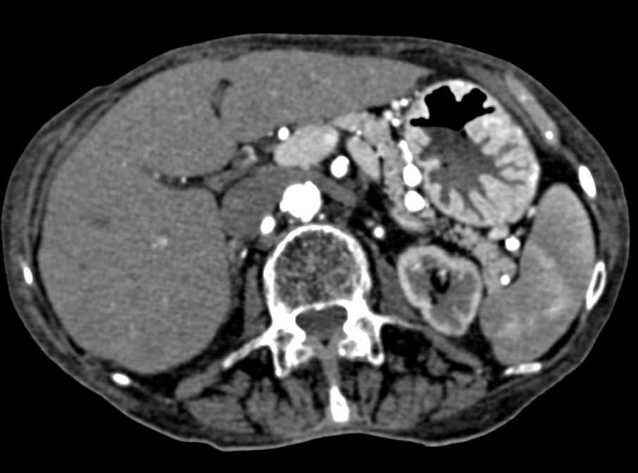 Zollinger-Ellison Syndrome with Thickened Gastric Folds - CTisus CT Scan