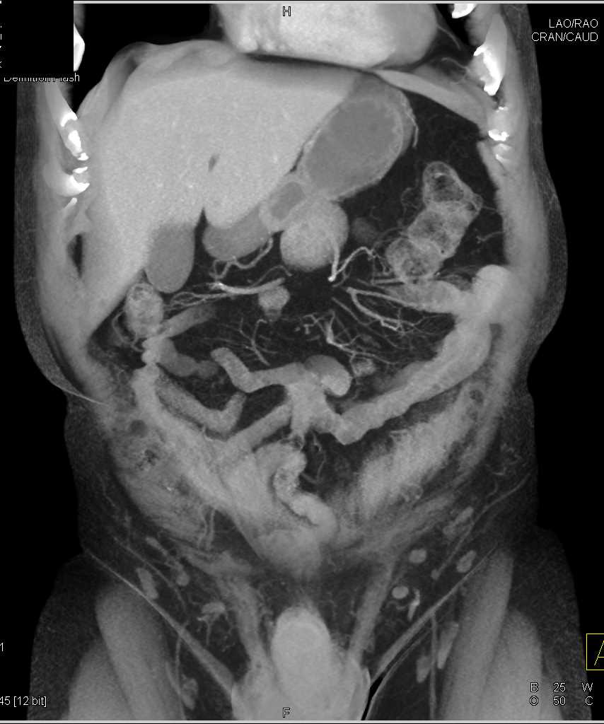 Gastric GIST Tumor Which is Exophytic - CTisus CT Scan