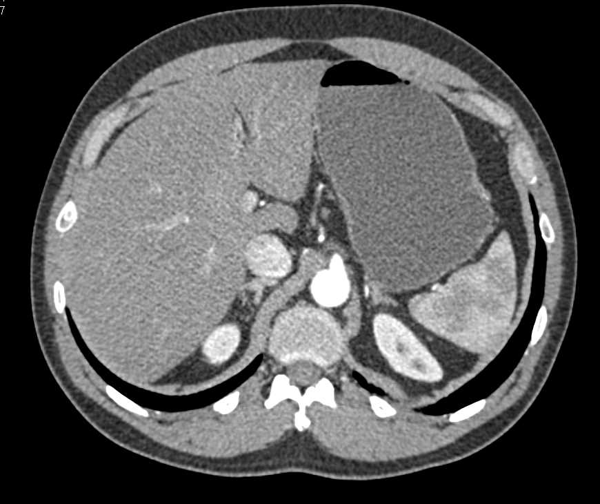 Gastric GIST Tumor Which is Exophytic - CTisus CT Scan