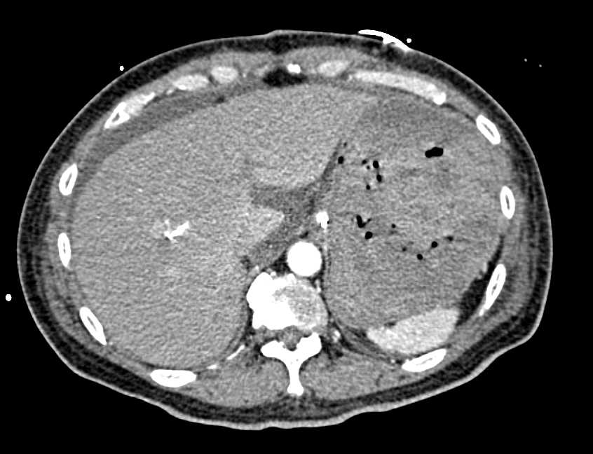 Gastric Adenocarcinoma with Active Gastric Bleed - CTisus CT Scan