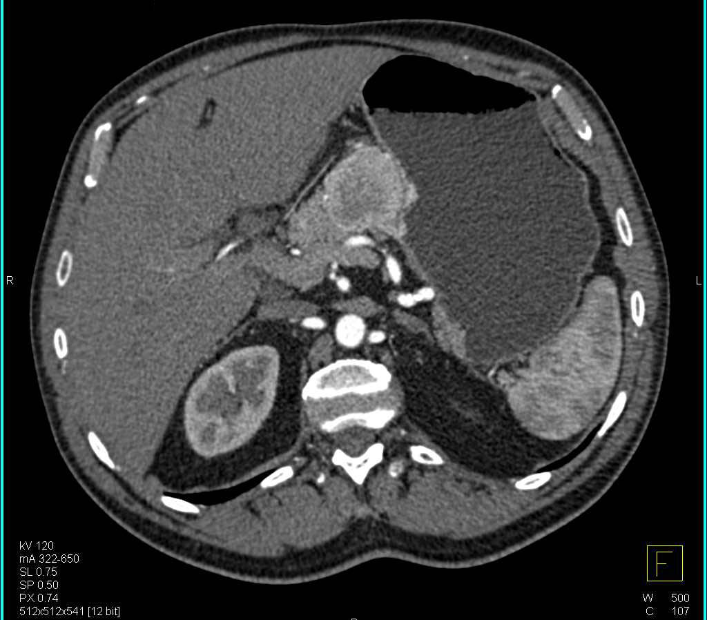 Gastric Carcinoid Tumor with Vascular Metastases to Nodes Looking Like a Pancreatic Mass - CTisus CT Scan