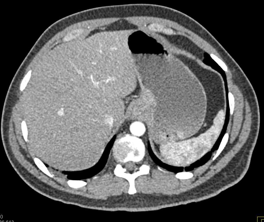 Gastric Cancer at Gastroesophageal (GE) Junction with Extensive Adenopathy - CTisus CT Scan