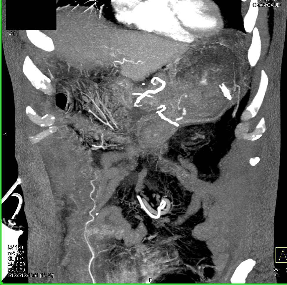 Infiltrating Gastric Adenocarcinoma - CTisus CT Scan