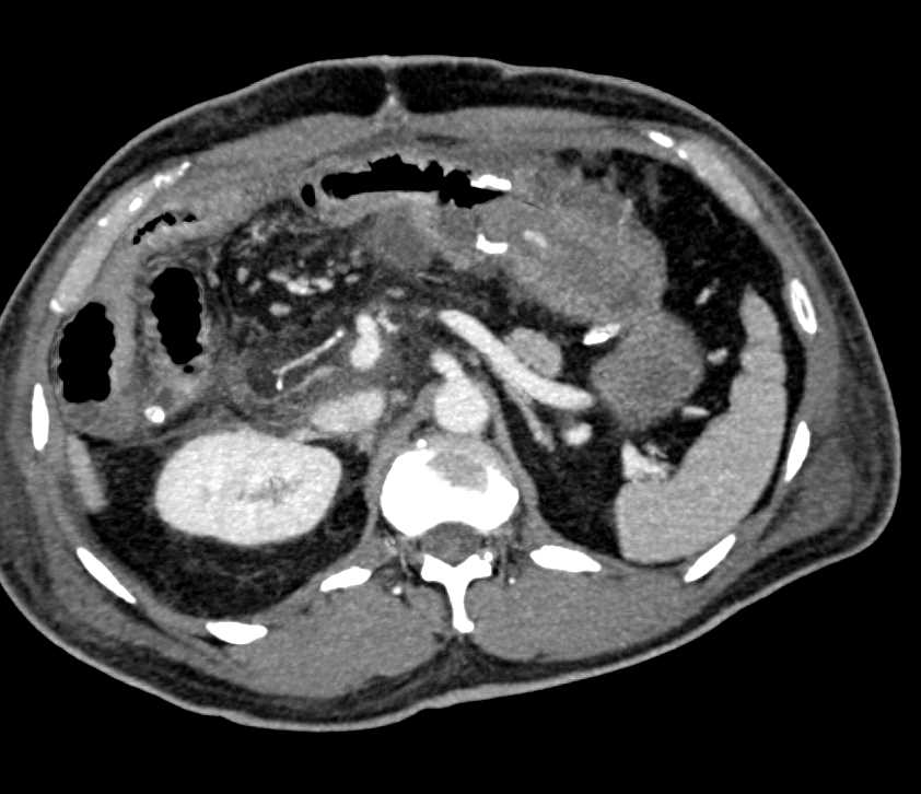 Infiltrating Gastric Adenocarcinoma - CTisus CT Scan