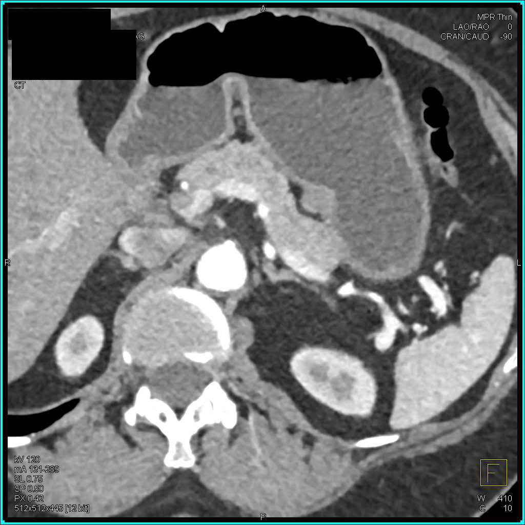 2cm Gastric GIST Tumor - CTisus CT Scan