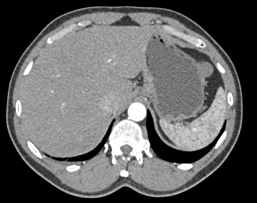 2cm GIST Tumor Arising off the Stomach - CTisus CT Scan