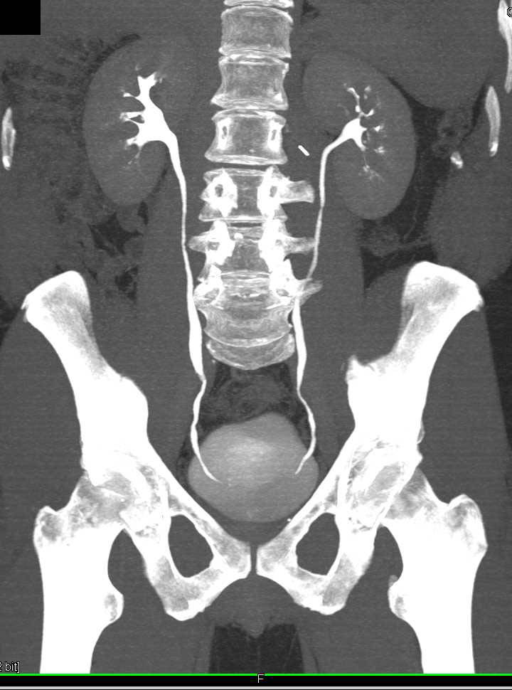 Focal Gastric Adenocarcinoma - CTisus CT Scan