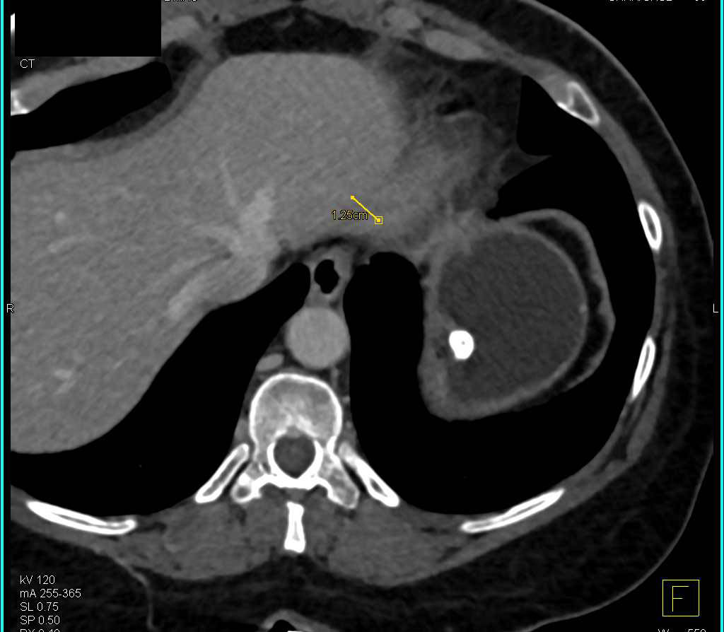 Calcified Leiomyoma in the Stomach - CTisus CT Scan