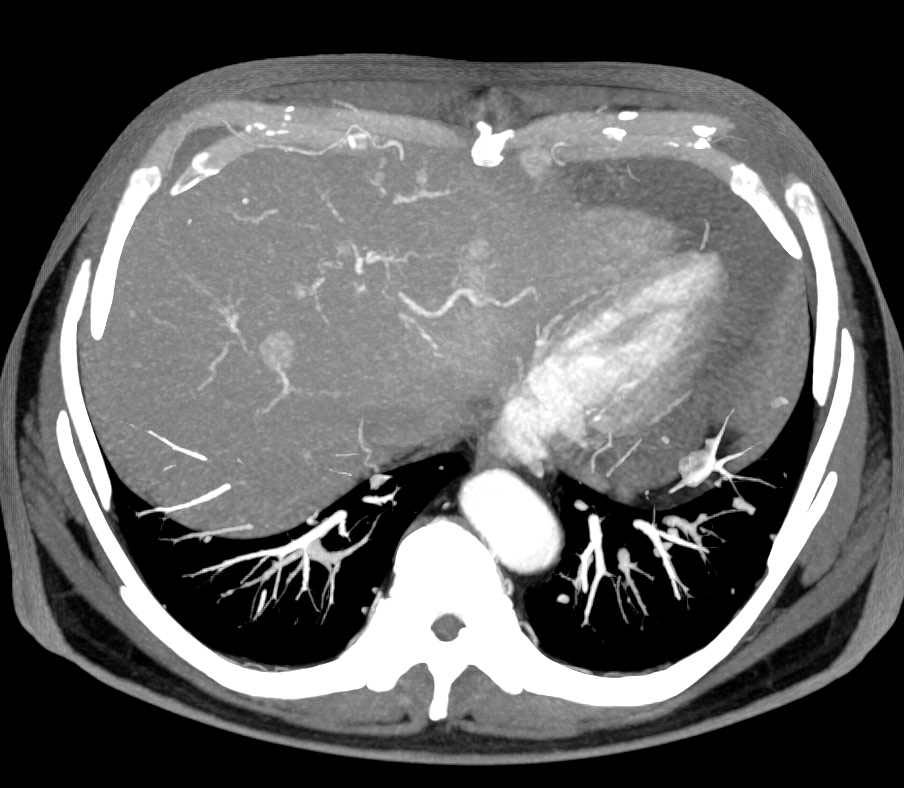 Metastatic Renal Cell Carcinoma to  Liver and Pancreas and Stomach - CTisus CT Scan