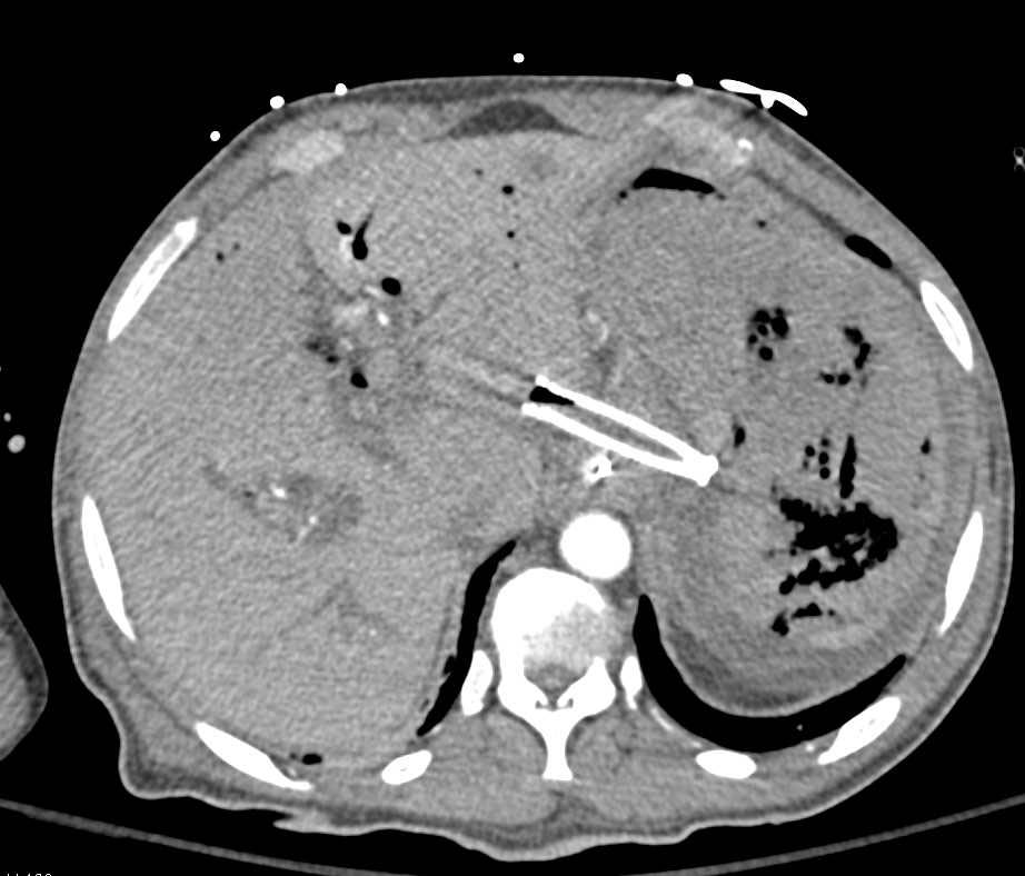 Infarction of the Stomach - CTisus CT Scan