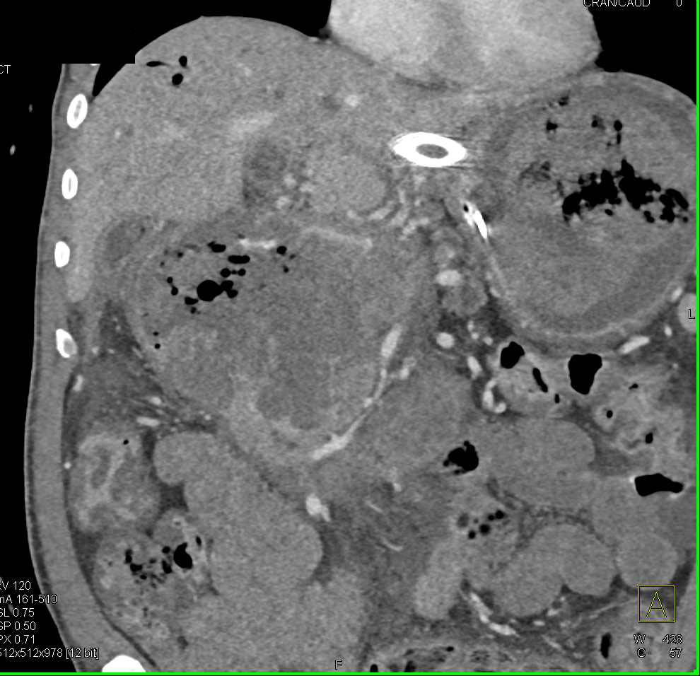 Gastric Cancer with Necrosis and Carcinomatosis - CTisus CT Scan