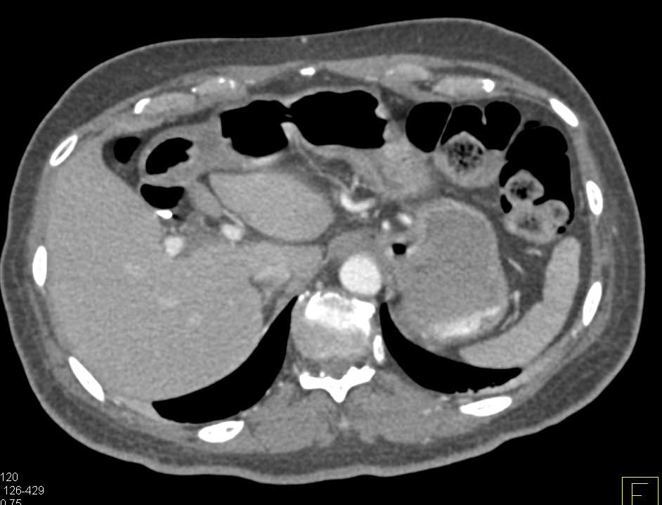 Subtle Gastric Adenocarcinoma - CTisus CT Scan