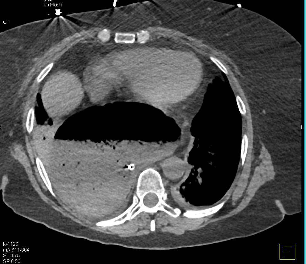 Gastric Volvulus - CTisus CT Scan