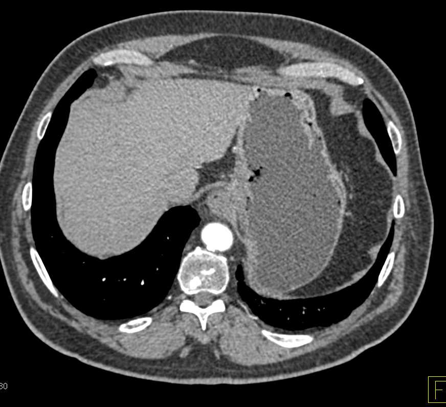 Gastric Cancer at the EG Junction - CTisus CT Scan