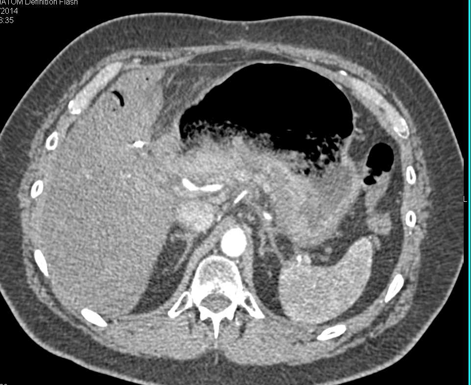 Gastric Outlet Obstruction - CTisus CT Scan