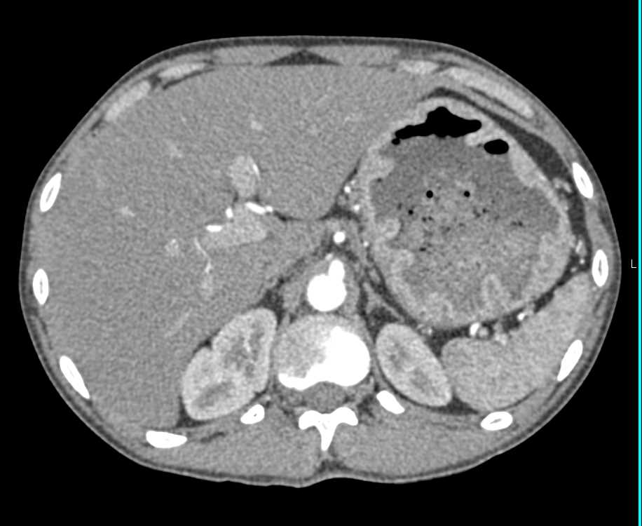 Diffuse Gastric Fold Thickening due to Zollinger-Ellison Syndrome - CTisus CT Scan