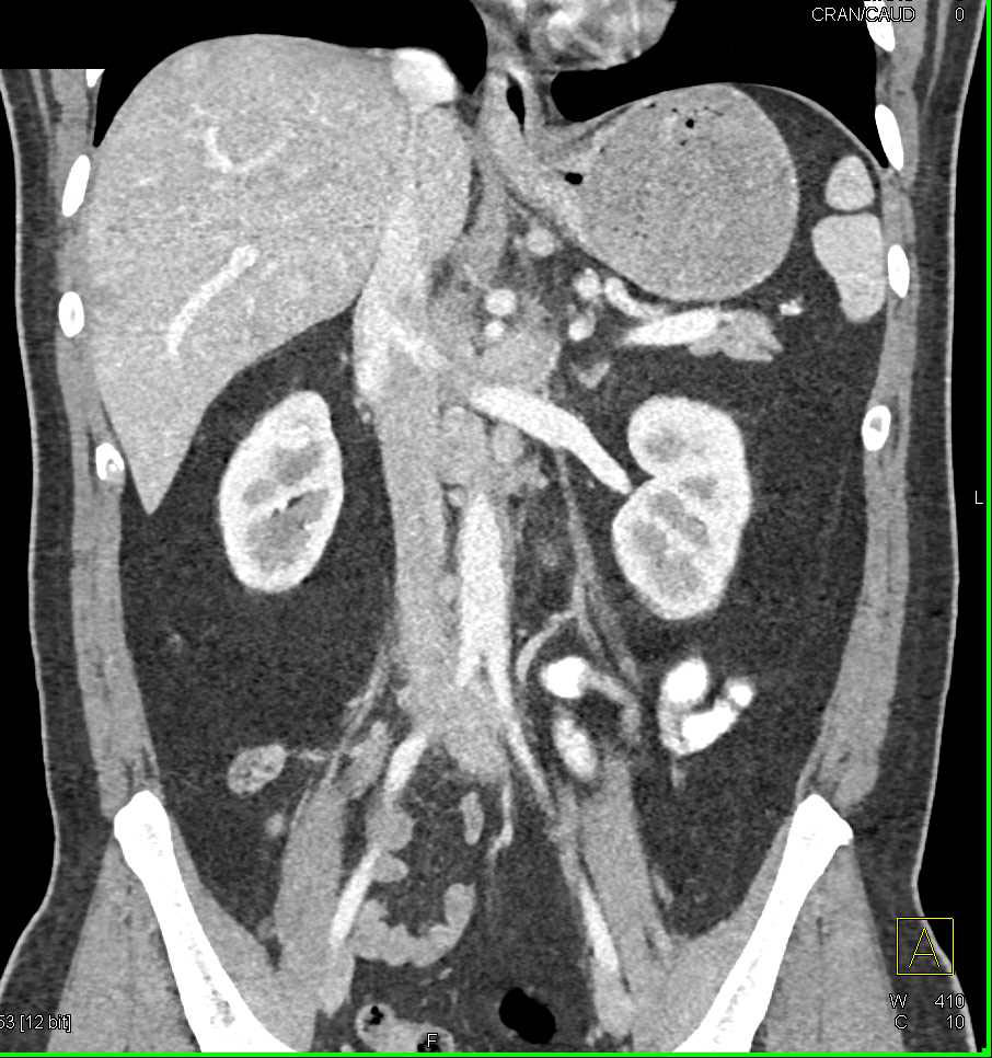 Carcinoma Gastroesophageal (GE) Junction with Liver Metastases and Adenopathy - CTisus CT Scan