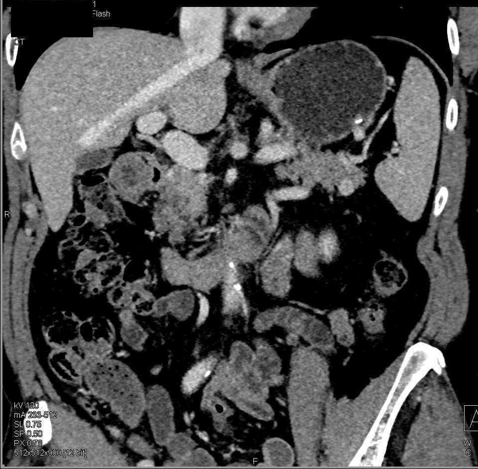 Subtle Carcinoma of the Gastric Antrum - CTisus CT Scan