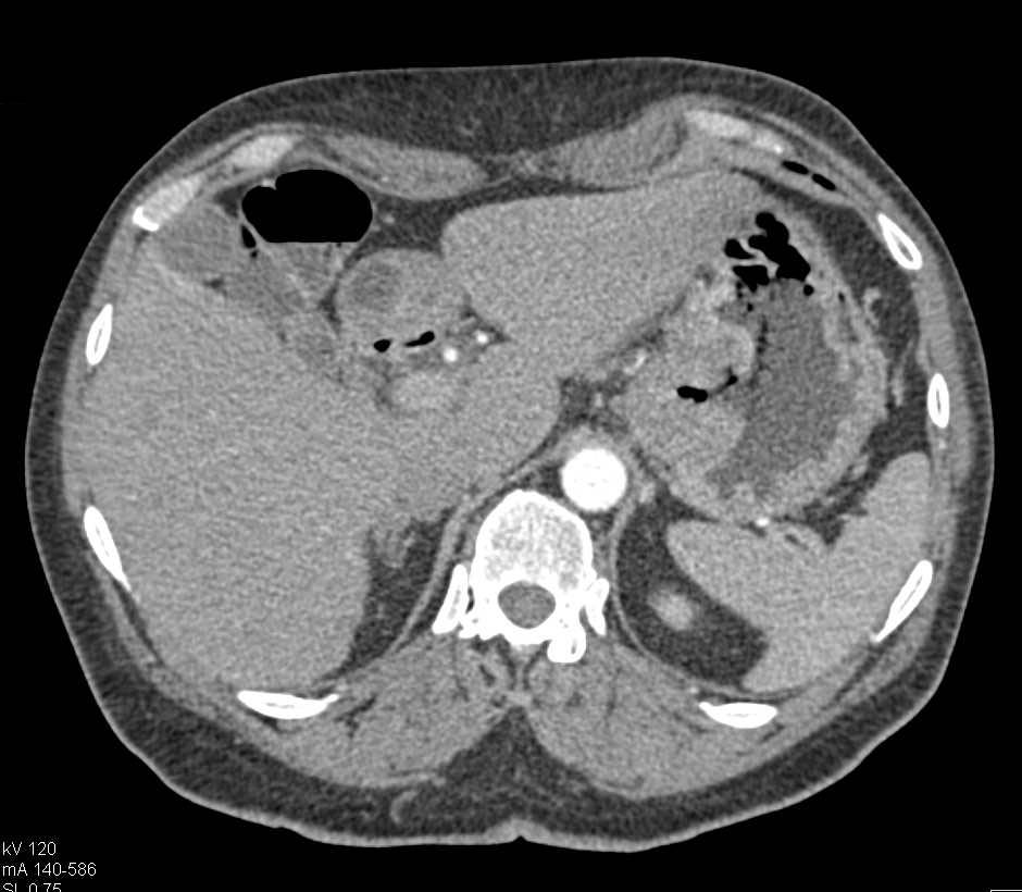 Ulcerating GIST Tumor Near Gastroesophageal (GE) Junction - CTisus CT Scan