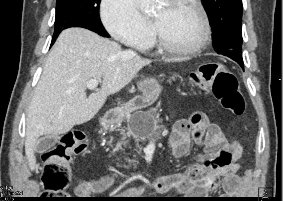 Gastric Volvulus - CTisus CT Scan