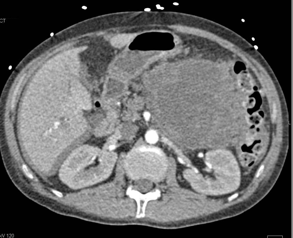 Gastric GIST Tumor - CTisus CT Scan