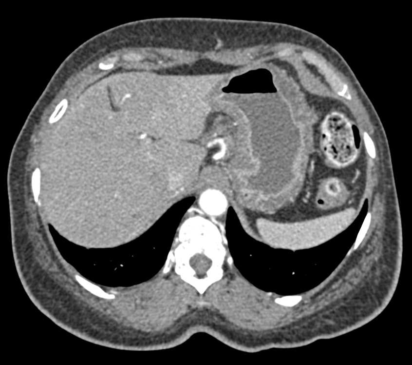 Infiltrating Gastric Adenocarcinoma with Celiac Adenopathy - CTisus CT Scan