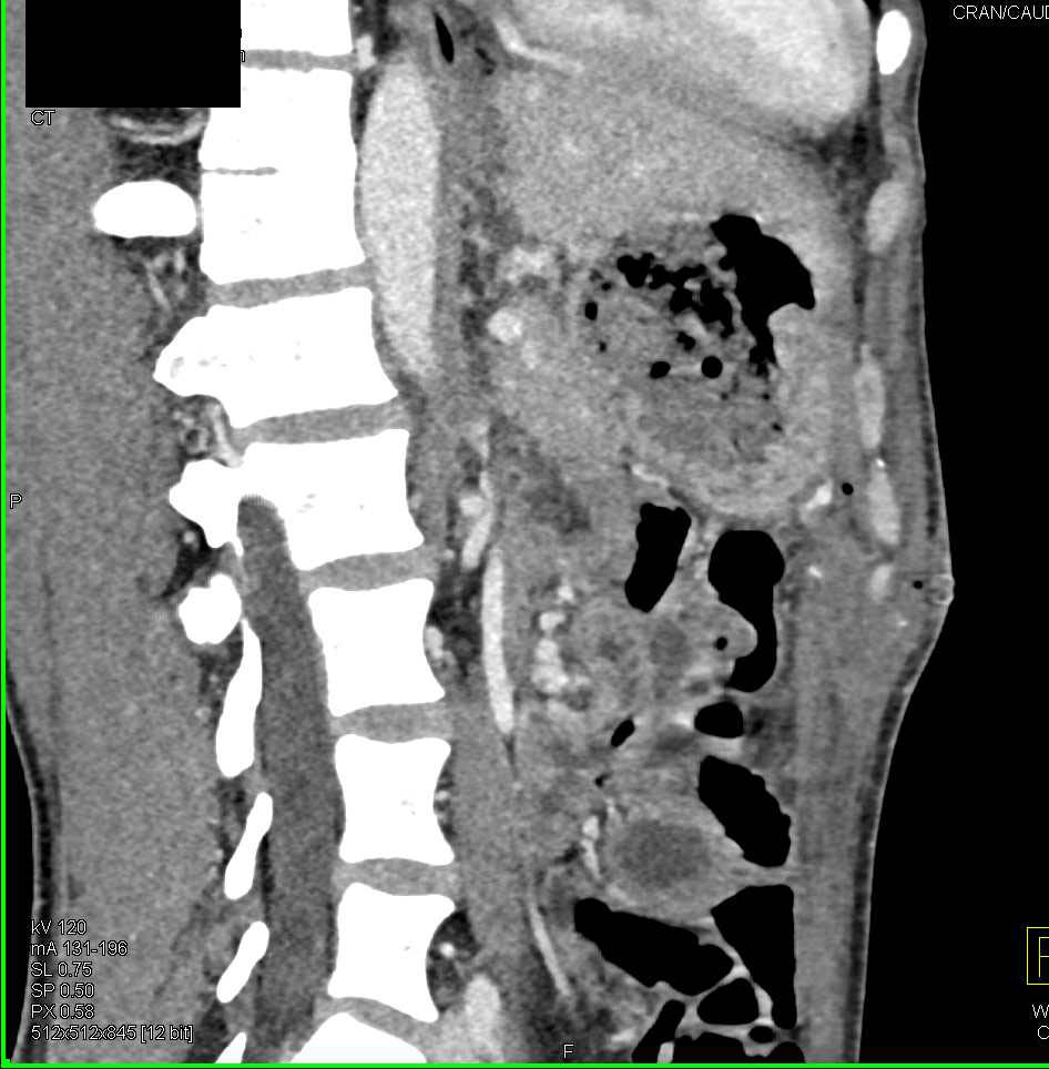 Gastric Adenocarcinoma with Ulcer - CTisus CT Scan