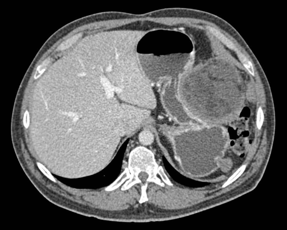 Omental Infarct Simulates a Gastric Mass or Tumor Recurrence - CTisus CT Scan