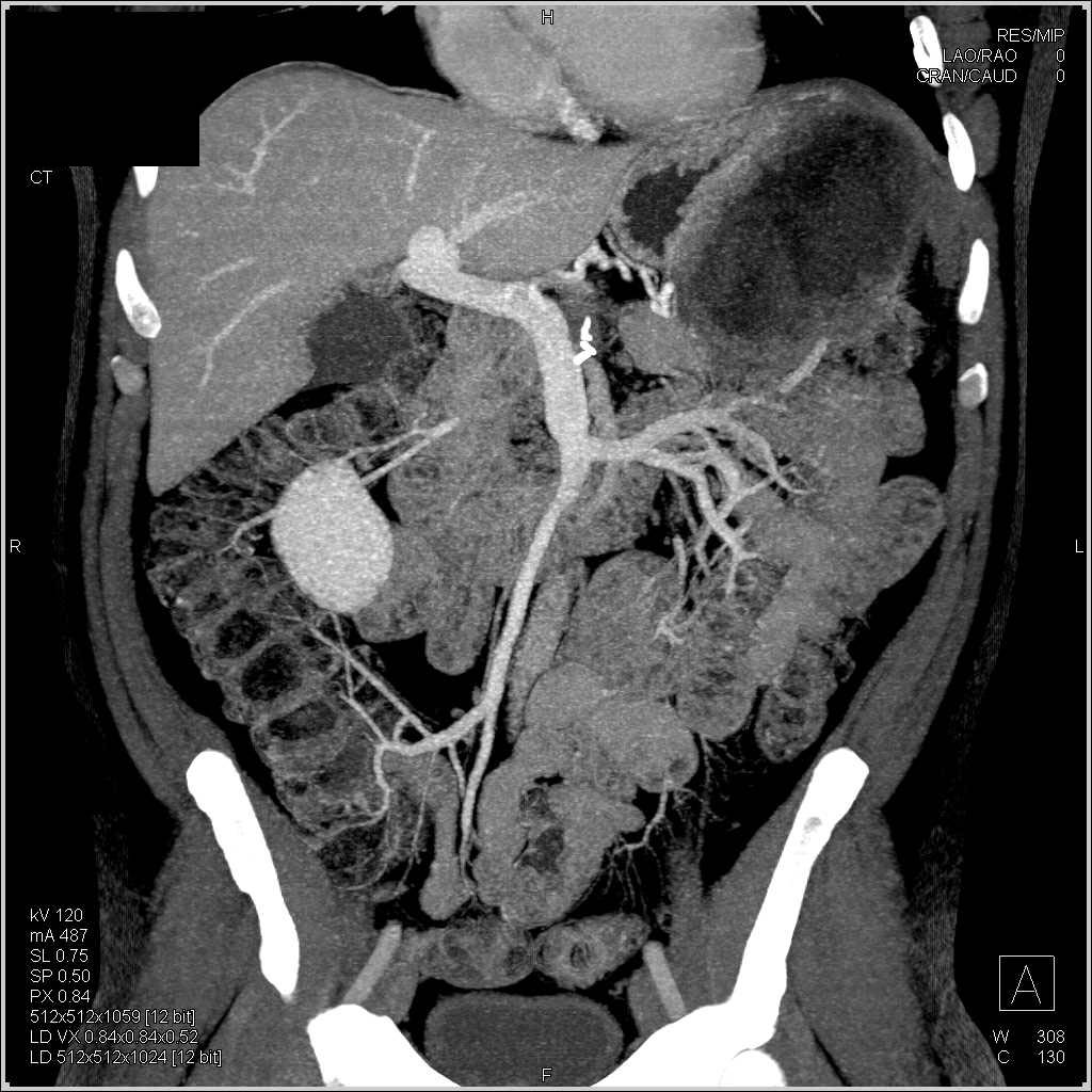 Omental Infarct Simulates a Gastric Mass or Tumor Recurrence - CTisus CT Scan