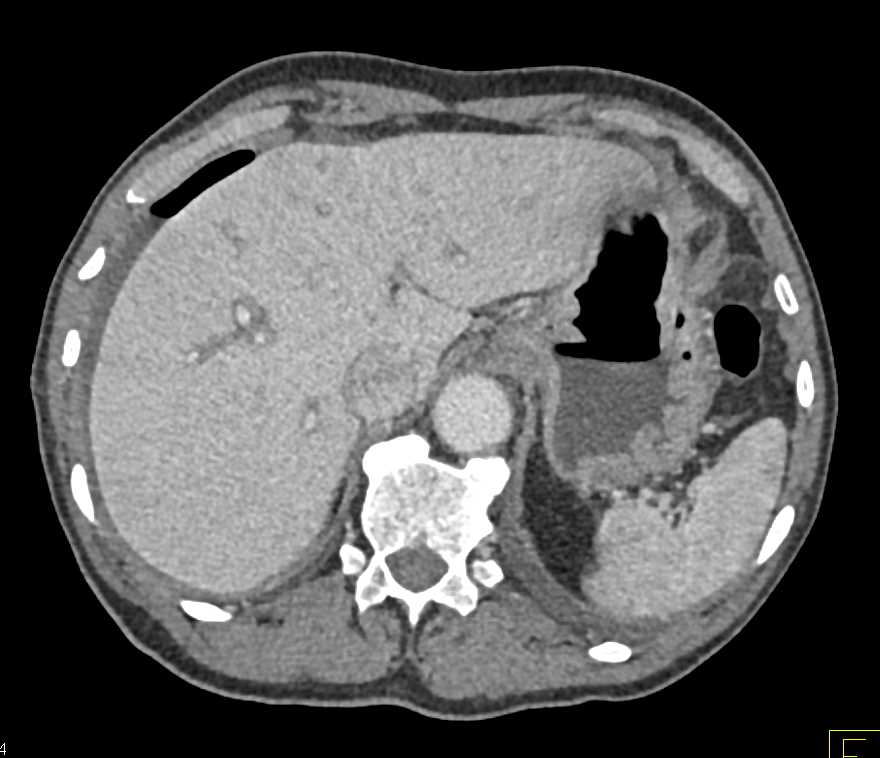 Pneumoperitoneum Due To Perforated Gastric Ulcer - CTisus CT Scan