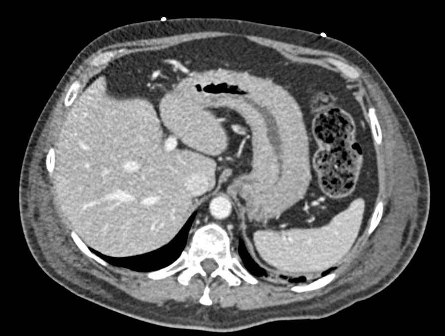 Linnets Plastica Stomach with Tumor Infiltration - CTisus CT Scan