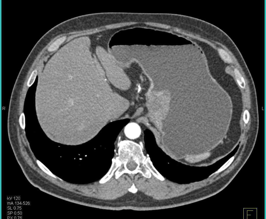 Gastric Cancer with Adenopathy - CTisus CT Scan