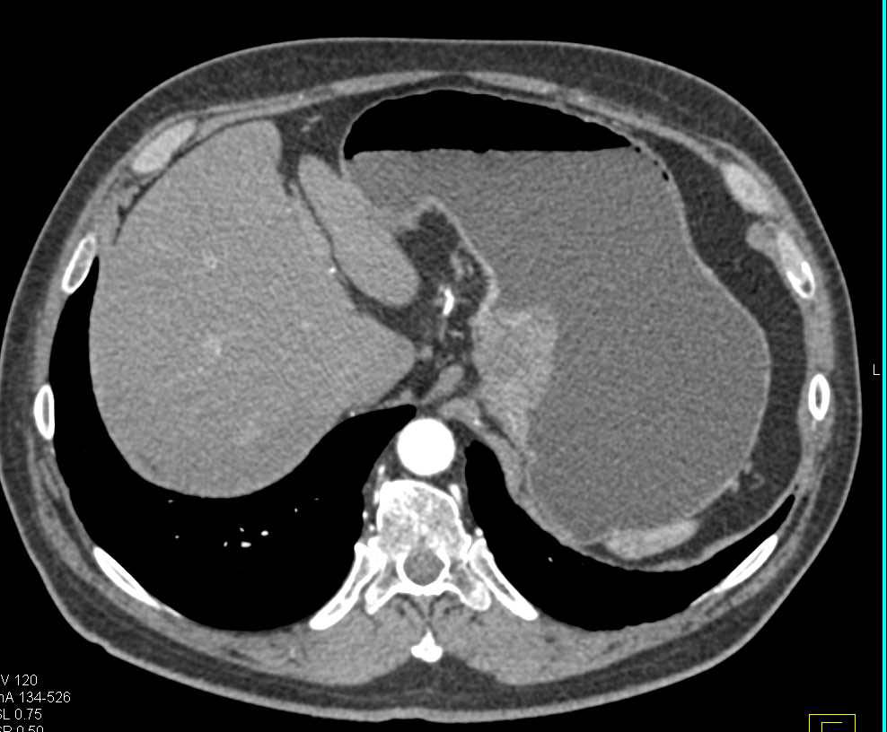 Gastric Cancer with Bulky Para-aortic Adenopathy - CTisus CT Scan