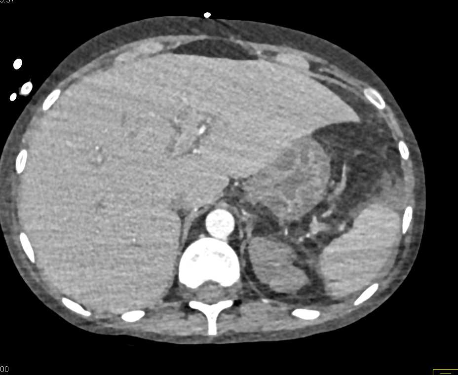 G-tube outside of the Stomach - CTisus CT Scan