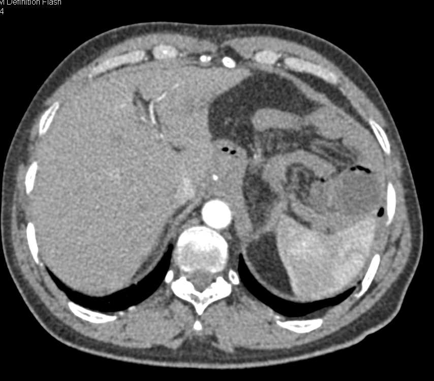 Gastric Resection - CTisus CT Scan