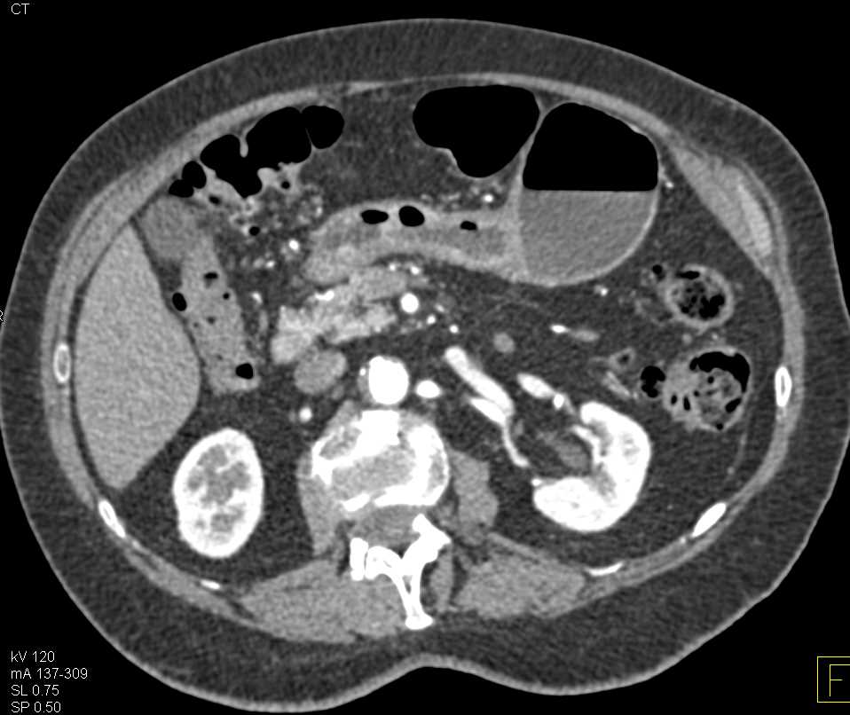 Carcinoma of the Gastric Antrum - CTisus CT Scan