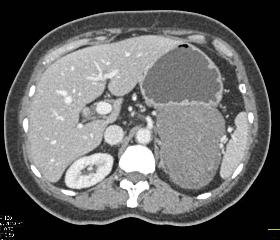 Gastric GIST Tumor - Stomach Case Studies - CTisus CT Scanning