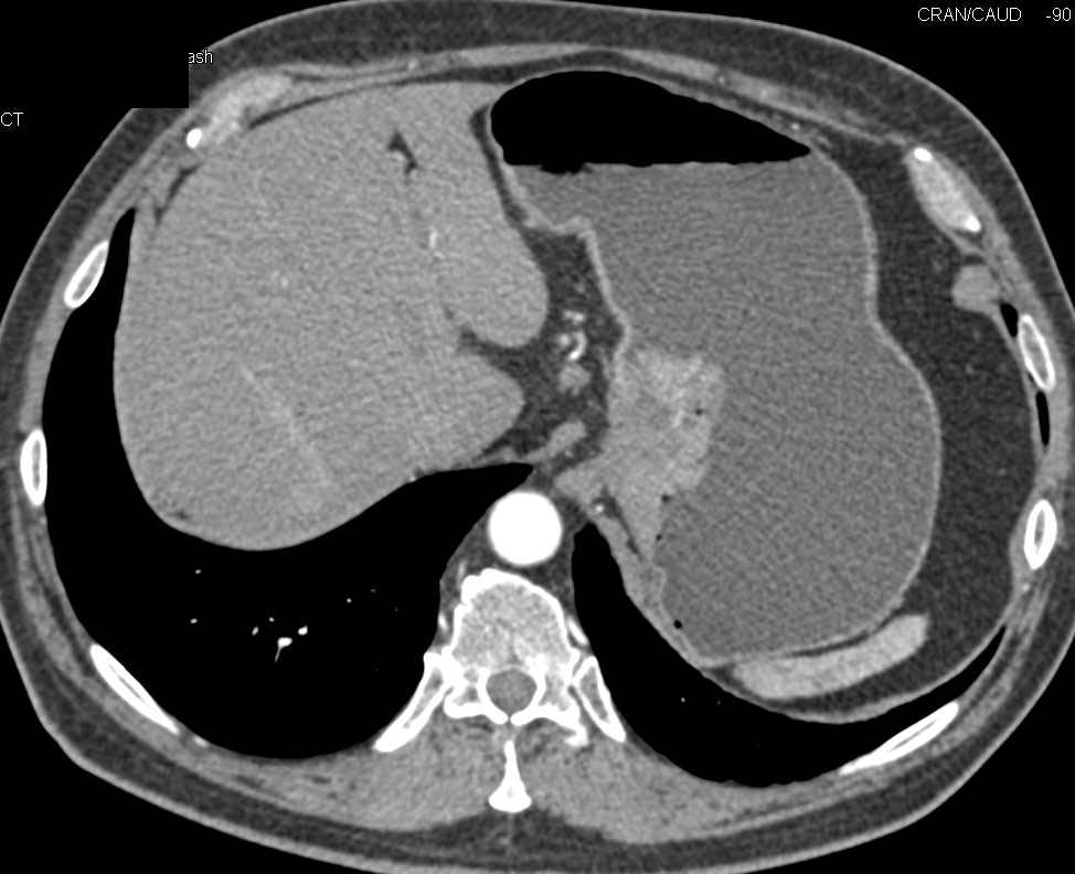 Gastric Carcinoma with Large Portocaval Nodes That Simulate a Pancreatic Mass - CTisus CT Scan