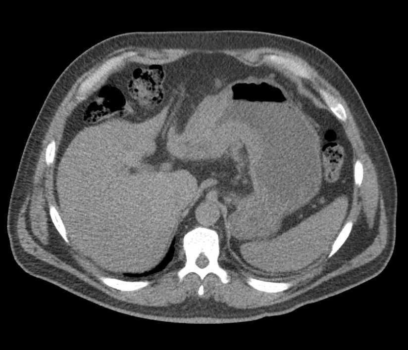 Gastric Carcinoma with Infiltrating Gastric Carcinoma in Antrum - CTisus CT Scan