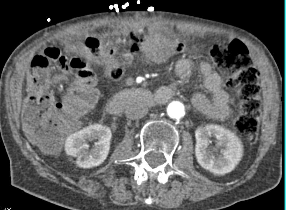 Perforated Stomach with Abscess - CTisus CT Scan