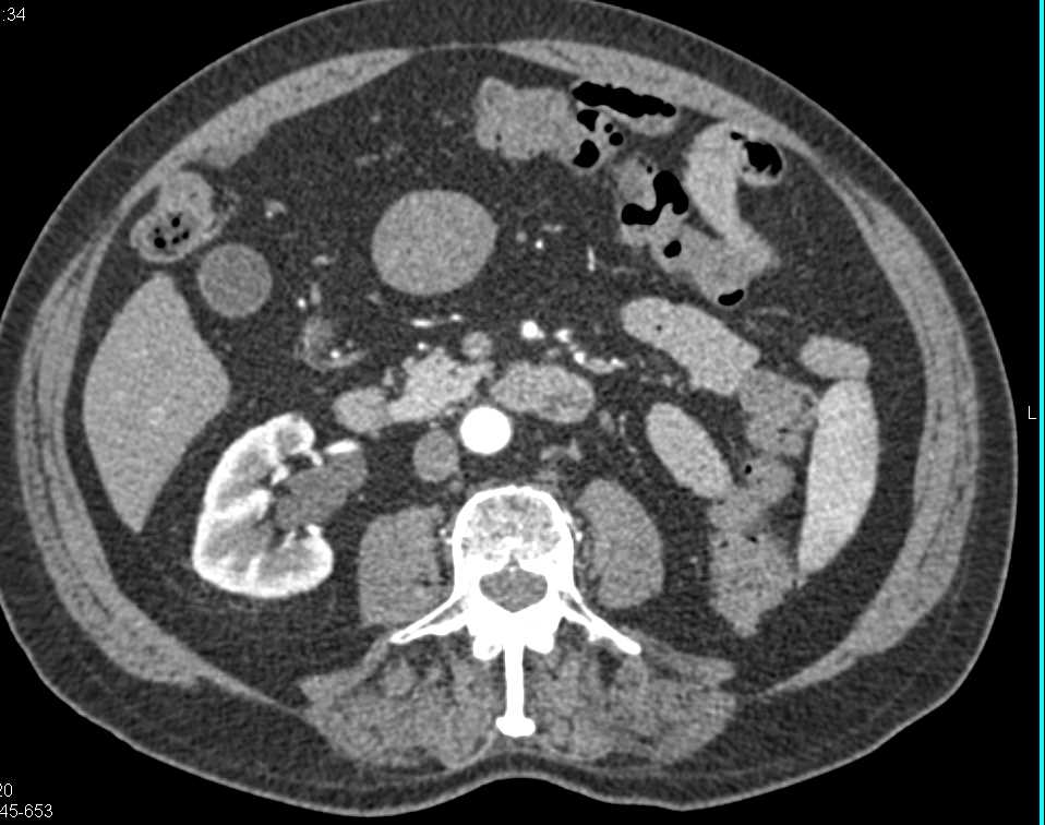 Exophytic Gastric GIST Tumor - Stomach Case Studies - CTisus CT Scanning