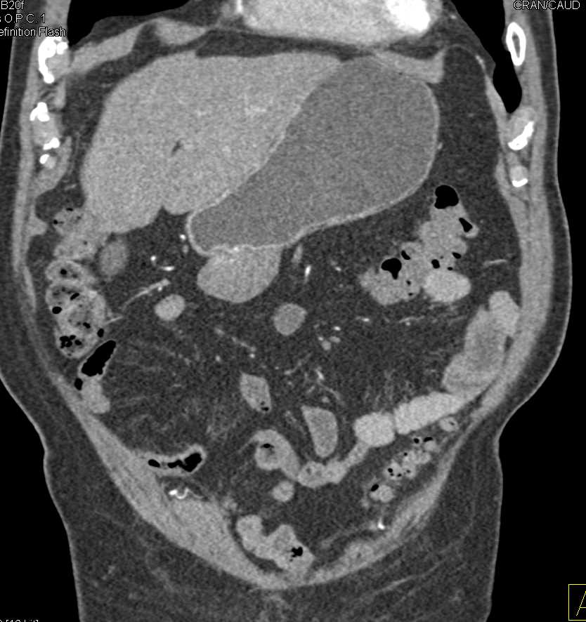 Exophytic Gastric GIST Tumor - CTisus CT Scan