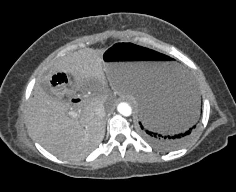 Liver Infarction and Emphysematous Gastritis - CTisus CT Scan