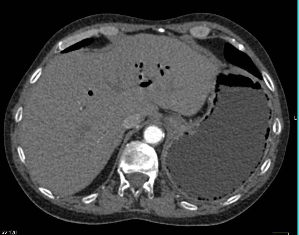 Gastric Emphysema - CTisus CT Scan