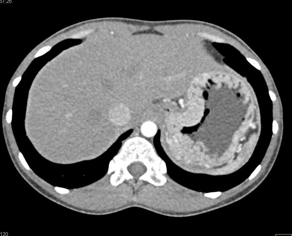 Infiltrating Gastric Adenocarcinoma with Celiac Adenopathy - CTisus CT Scan