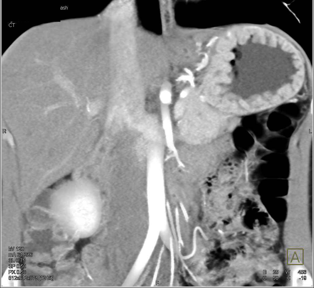 Infiltrating Gastric Adenocarcinoma - CTisus CT Scan