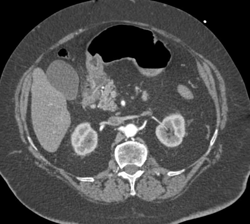 Carcinoma of Gastric Antrum - CTisus CT Scan