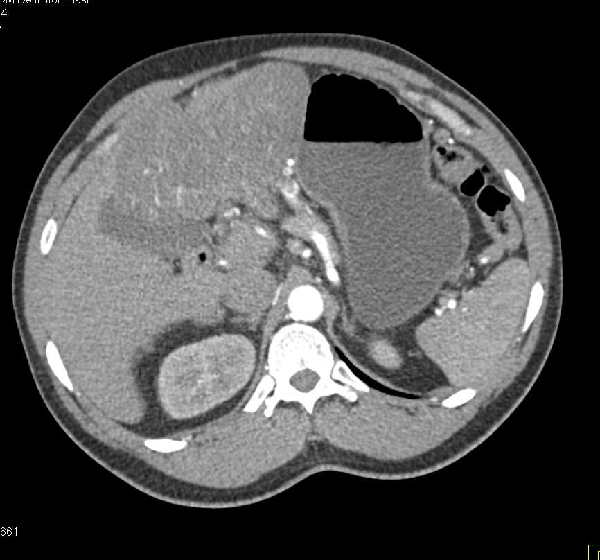 Large Abdominal GIST Tumor with Relationship to the Liver - CTisus CT Scan